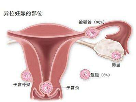 【宫外孕概率有多大】宫外孕的概率有多高_宫外孕的发生率是多少