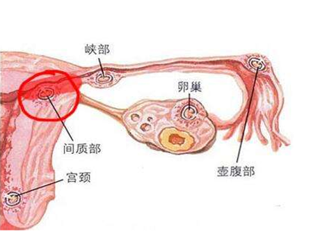 【宫外孕概率有多大】宫外孕的概率有多高_宫外孕的发生率是多少