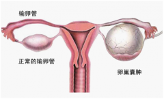 女性卵巢囊肿多发，如何对症下药？