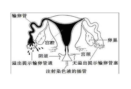 输卵管造影后多久可以要孩子：专家建议3个月到半年